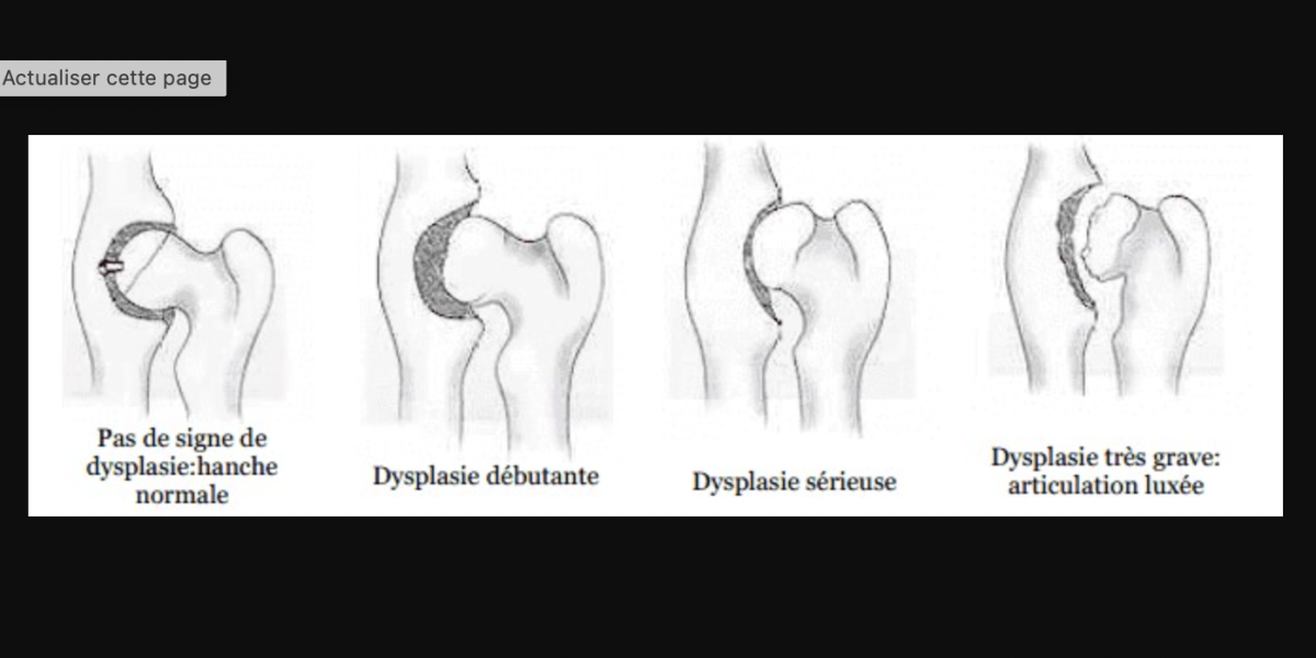 La dysplasie coxo-fémorale.