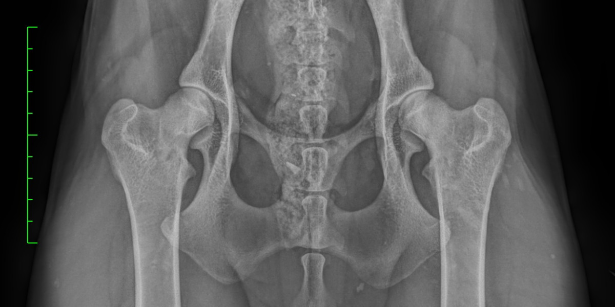 Classification de la dysplasie de la hanche