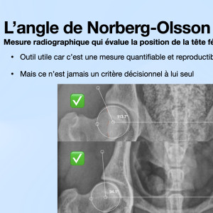 Classification de la dysplasie de la hanche